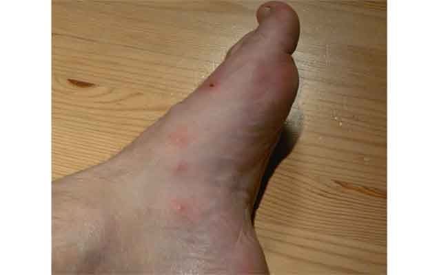 اعراض جلدية قد تعانون منها في حال الإصابة بفيروس كورونا!