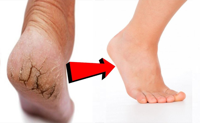 كيف يمكن التخلص من تشققات القدمين منزلياً؟