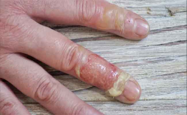 كيف تُعالج حروق الماء الساخن؟