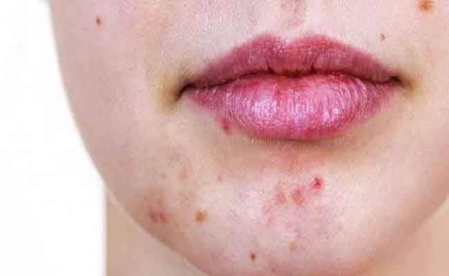 للحدّ من بثور البشرة المزعجة…إليك هذه النصائح