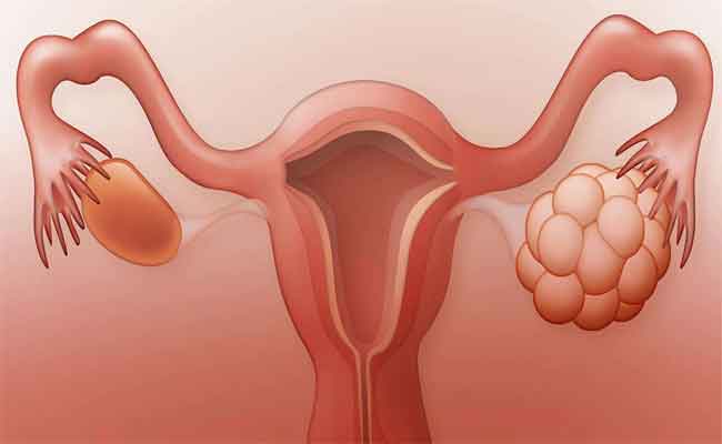 هل صحيح ان تكيس المبايض يمنع الدورة الشهرية؟