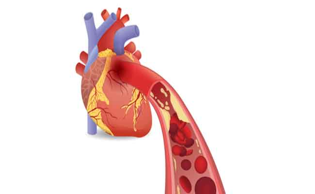 شرايين القلب المسدودة تهدّد الحياة…فكيف يمكن علاجها؟