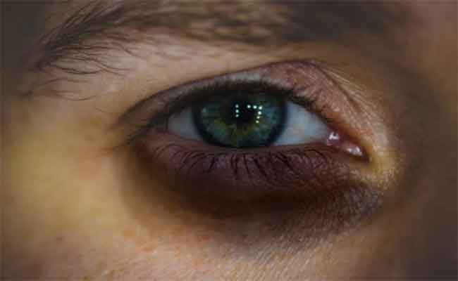 هل التدخين يسبب هالات سوداء حول العينين؟