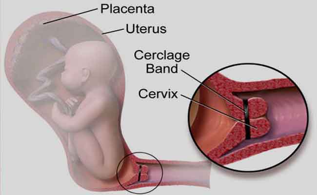 في أي حالاتِ تحتاجين الى ربط عنق الرحم خلال الحمل؟