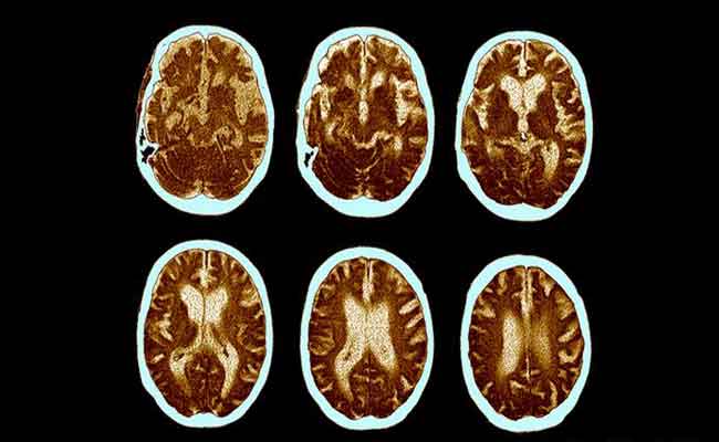 دراسة جديدة حول العلاقة بين الزهايمر وكورونا…ماذا كشف العلماء؟