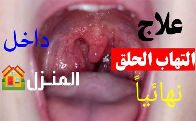 كيف يمكن علاج احتقان الحلق في المنزل؟