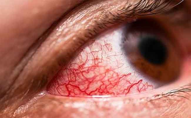 ما العلاقة بين مشاكل العينين ونقص الفيتامين د؟