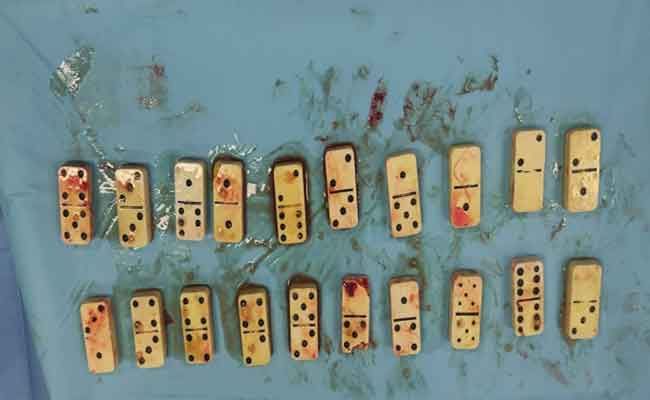 إنقاذ شاب ابتلع 20 قطعة دومينو بالأغواط