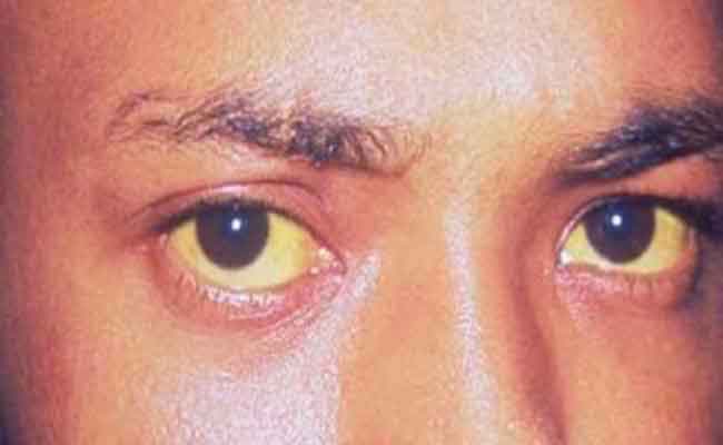 ما هي الأطعمة المفيدة لمريض الصفراء والتي تسرّع عملية شفائه؟