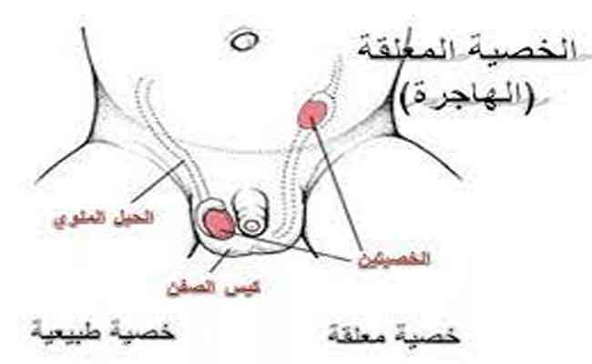 ما هي المضاعفات الصحية لوجود الخصية خارج كيس الصفن؟