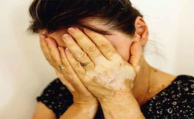 هل يعتبر البهاق من الامراض المعدية؟