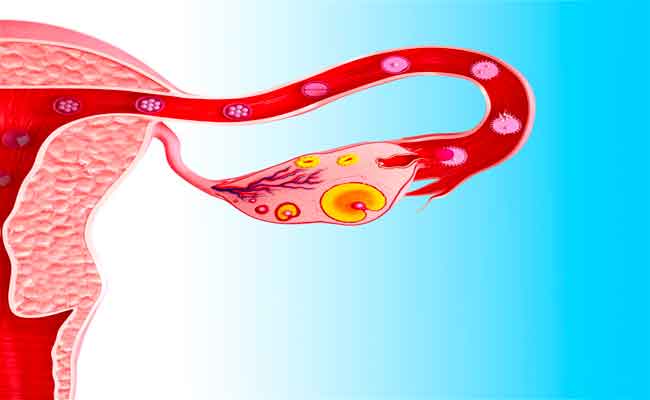 ما الذي يجب أن تعرفيه عن قصور المبيض الأولي؟