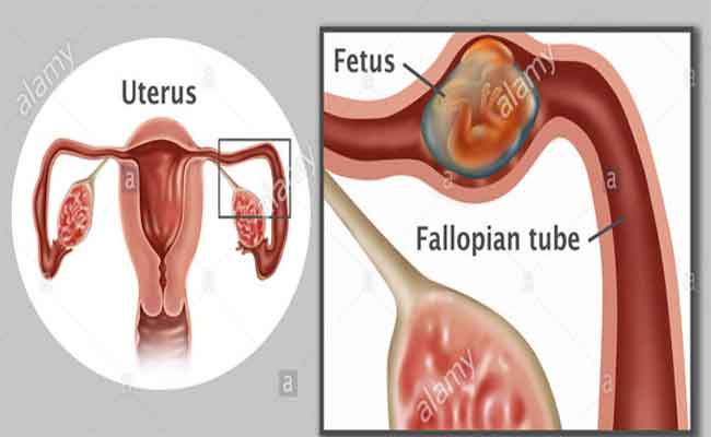 هل يمنع الحمل خارج الرحم حصول الدورة الشهرية؟