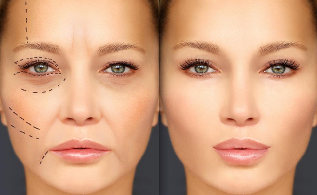 هل تفكّرين باجراء جراحة تحديد الجفون؟ اليكِ ما يجب أن تعرفيه عنها