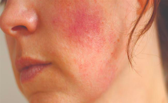 كيف يمكن أن تحمي بشرتكِ من الالتهابات؟