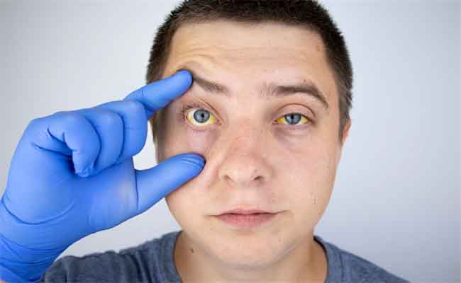 ما هي الأطعمة المفيدة لمريض الصفراء والتي تسرّع عملية شفائه؟