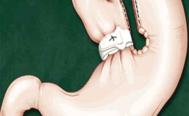 عملية تكميم المعدة…ما هي أضرارها المحتمَلة؟