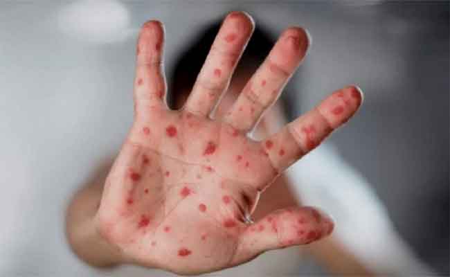 عزل مخالطي المصابين بجدري القردة ضرورة…وهذه هي التدابير المتبعة!