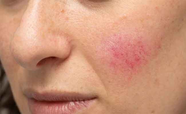 بهذه الخطوات يمكنك حماية بشرتك من الاحمرار في الصيف