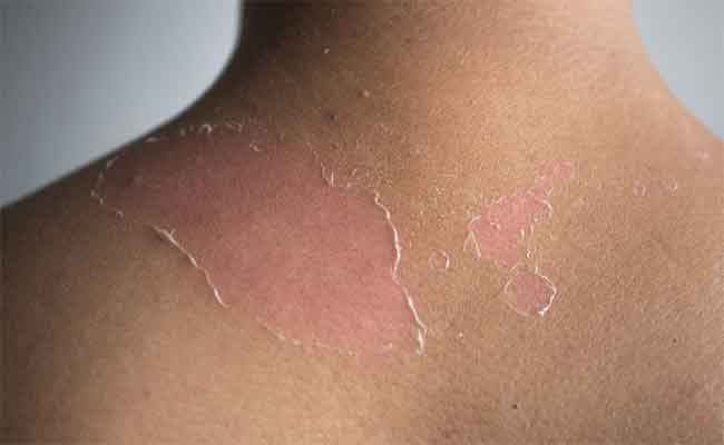 6 نصائح هامة للوقاية من الفطريات الجلدية في الصيف…