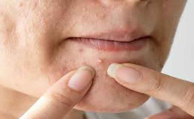 حبّ الشباب بعد الولادة…هل يُعتبر أمراً طبيعياً؟