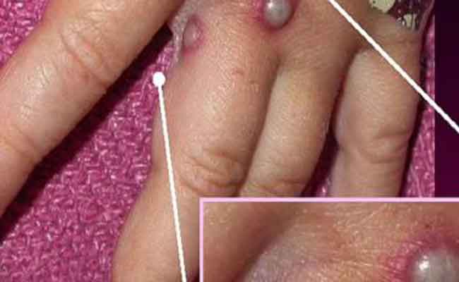 كيف ينتقل جدري القرود؟ حقائق من المهمّ أن تعرفوها…