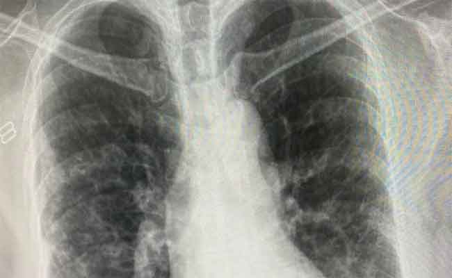 هل الأعراض التي تعانون منها تشير الى التهاب رئوي؟