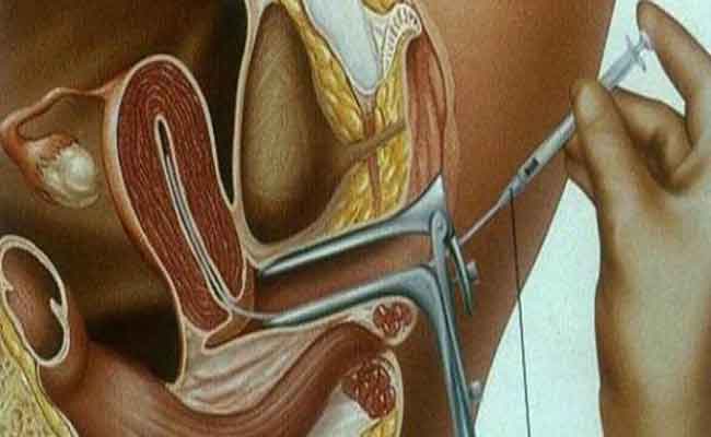 متى ينصح الطبيب بالتلقيح الصناعي؟ وهل هو إجراء مؤلم؟