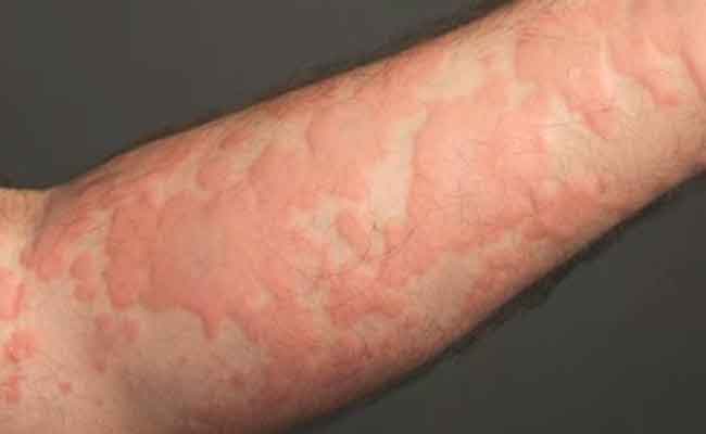 ما الذي يجب أن تعرفوه عن حساسية الارتكاريا المؤلمة والمزعجة؟