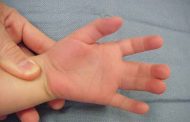 لماذا قد يولد الطفل بأصابع ملتصقة؟ وما هو الحل؟