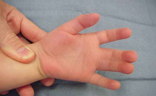 لماذا قد يولد الطفل بأصابع ملتصقة؟ وما هو الحل؟