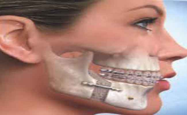 هل من مخاطر في الخضوع إلى جراحة الفك؟