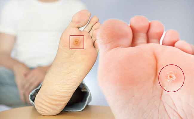 كيف يمكنكم علاج مسمار القدم بسهولة في المنزل؟