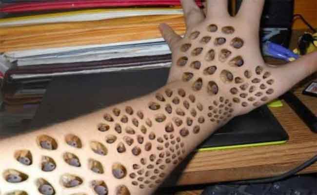 ما هي فوبيا الثقوب؟ وهل من علاج لها؟