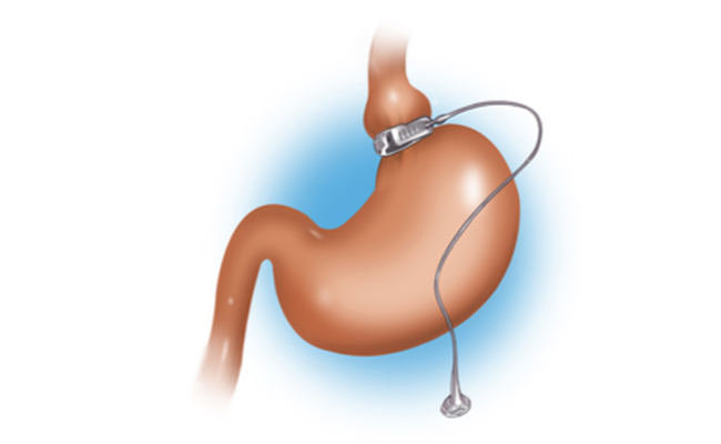 هل حان الوقت لاجراء عملية ربط المعدة؟