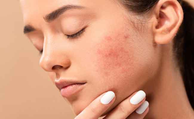 بهذه الخطوات يمكنك حماية بشرتك من الاحمرار في الصيف…