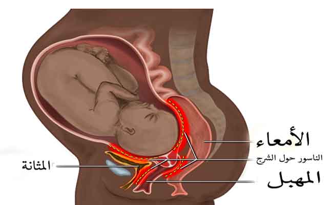 كلّ ما تريدين معرفته عن ناسور الولادة ومضاعفاته