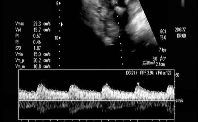 لماذا لا تسمعين دقّات قلب طفلكِ في بداية الحمل؟