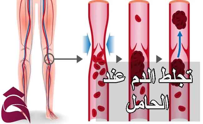 كيف تحمين نفسكِ من جلطات الدمّ خلال الحمل؟