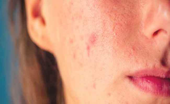 للحدّ من بثور البشرة المزعجة…إليك هذه النصائح