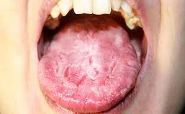 فطريات اللسان…ما أسبابها؟