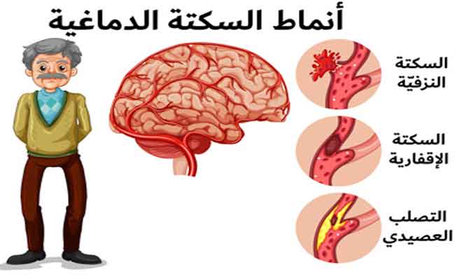 7 أشياء يمكنكم القيام بها للوقاية من السكتة الدماغية…