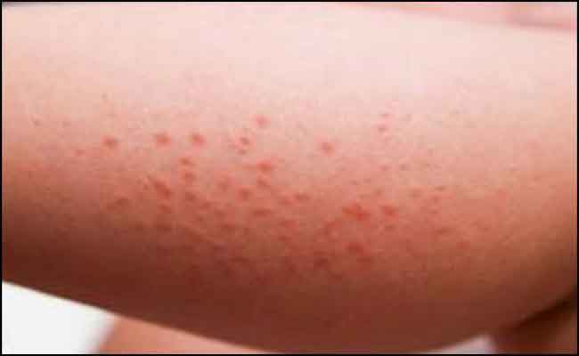 هل تعانون من حكّة الجلد؟ اليكم ما يسبّبها