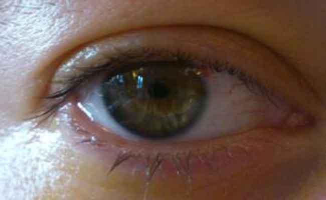 كيف يتمّ اجراء عملية زرع عدسة العين؟