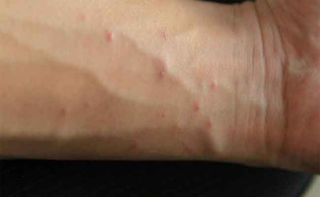 كيف يمكن التمييز بين الجرب والحساسية؟