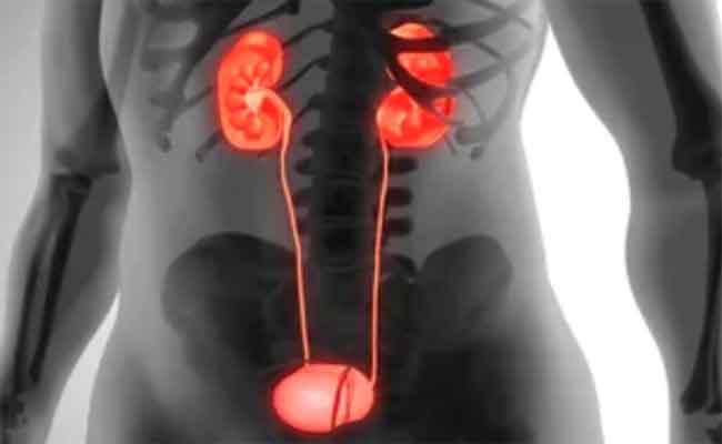 كيف يمكن ان تحموا أنفسكم من مشكلة حصى الكلى؟