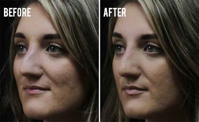 6 إجراءات ضرورية بعد تجميل الأنف…إهمالها يضرّ بالنتائج