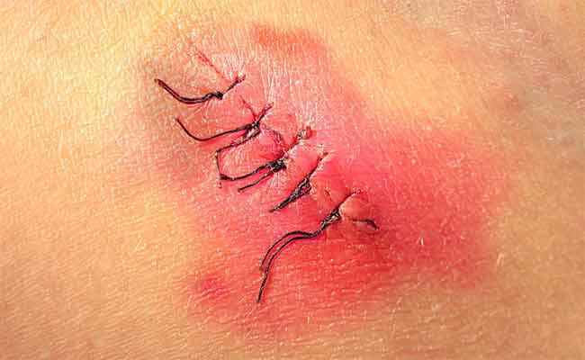 ما هي العلامات التي تدلّ على التئام جرح الولادة؟