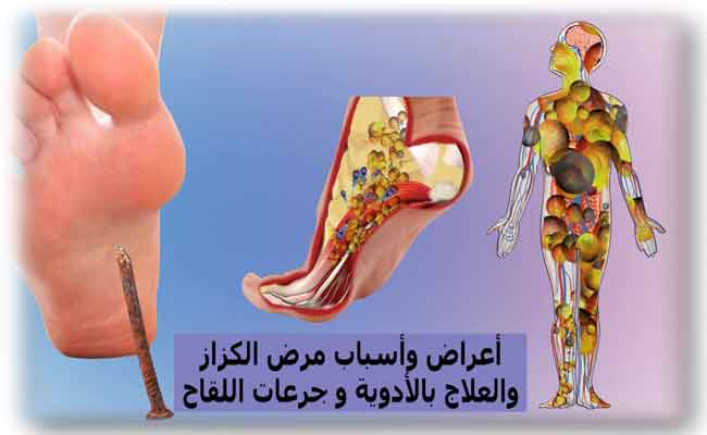 ما هو مرض الكزاز؟ وكيف يعمل لقاحه؟