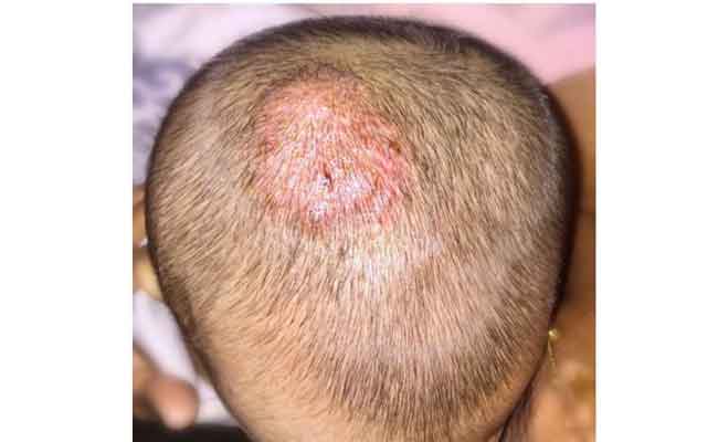 كلّ ما يجب ان تعرفوه عن سعفة الرأس وطريقة علاجها